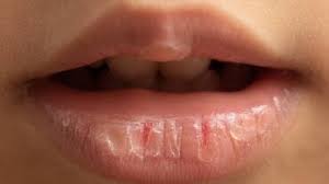 know why lips get dry in winters we