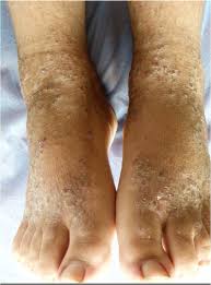 severe chronic lesions on the feet of