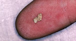 Kidney Stone Pictures Symptoms Causes Treatments And