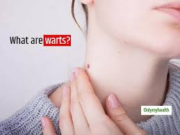 warts symptoms causes and treatment
