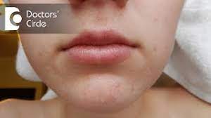 types of acne around the mouth and how