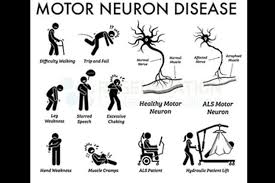 motor neurone disorder mnd mittal