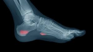 But even if you choose a less demanding style, such as hatha yoga, in which postures are performed at a slower pace, you may be surprised by how much of a workout you feel you have done. Causes And Prevention Of Stress Fractures In The Foot And Ankle Orthovirginia