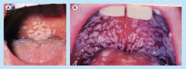 hiv infection