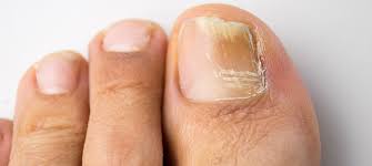 how to treat toenail fungus