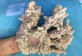 It causes warts to erupt on the body's limbs and is believed to be. Israeli Docs Save Gaza Dad S Hand From Tree Man Syndrome Israel21c