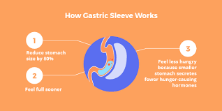 How Much Weight Could I Lose With Gastric Sleeve Surgery