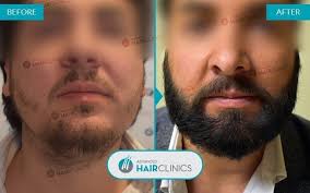 Once it is coarse and thick, that is when you should start slowly coming off it. Fue Beard Transplant