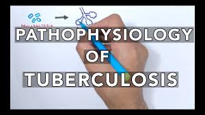 Pathophysiology Of Tuberculosis
