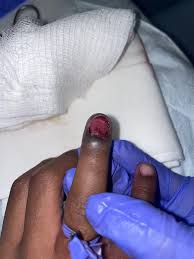 nail bed laceration