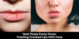 pouty pouts treating ed lips