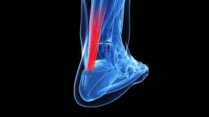 In the last few months, a lump has appeared on the old tear & aches regularly, not really stopping me. Achilles Tendon Injuries Johns Hopkins Medicine
