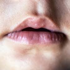 lip tie in es toddlers symptoms