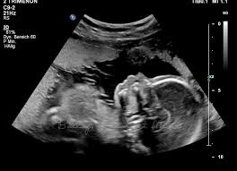 Woche im ultraschall zu sehen ist. Schwanger Mit Wunschbaby Nr 4 Von Der 20 Ssw Bis Zur 22 Ssw Familie Baby Kind Und Meer