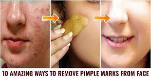 how to remove pimple marks from face