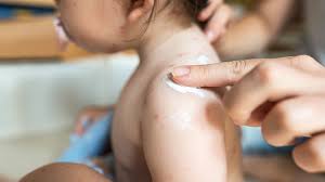 skin rashes in es and toddlers