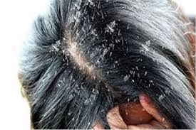 علاج قشرة الشعر الفطرية المهددة في محمية
