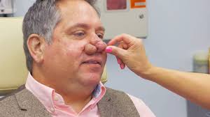 Lee examines a sizable growth in jen's ears that causes her pain and vertigo. Dr Pimple Popper Removes Man S Dangerous Nose Grapes Which Dangled From Nostrils
