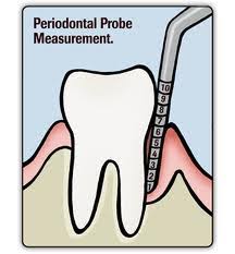 What Is Periodontal Charting