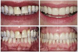 teeth whitening what treatments are