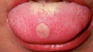 tongue ps 8 causes when to see a