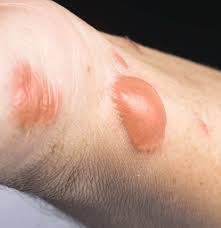 burn scars treatment removal and