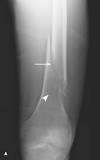 Image result for icd 10 code for pathological left femur fracture