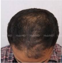does minoxidil cause hair loss hairmd