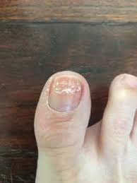 how to fix nails damaged by pedicures