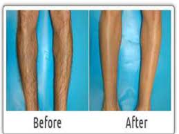There is an option to do it at home a whole lot cheaper. Pemex Energy Gurgaon Legs Hair Removal Benefits