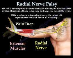 radial nerve palsy injury wrist drop