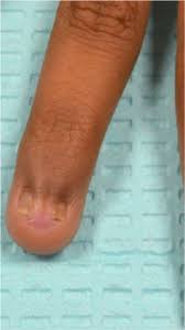 nail patella syndrome a report of a