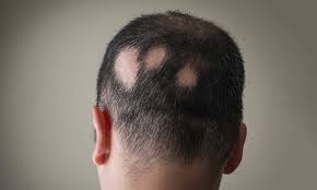 Alopecia areata is an autoimmune condition that causes hair to fall out in round patches. Learn About Alopecia Areata And How It Causes Hair Loss Hair Club