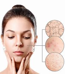 dry skin acne 14 home remes and