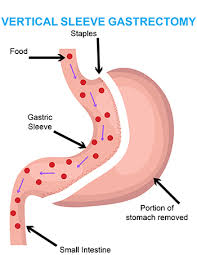 gastric sleeve