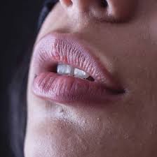 what is eczema on the lips klarity