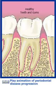 Types Of Gum Disease Perio Org
