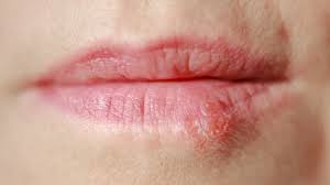 psoriasis on lips symptoms treatment