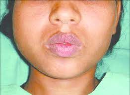 clinical photograph showing diffuse