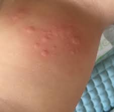 house dust mites allergy