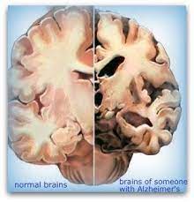brain injury from alzheimer s disease