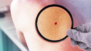 red moles causes and treatment of