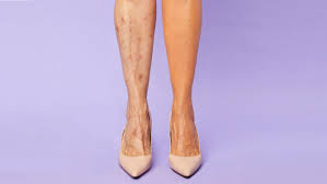 varicose veins tattoos