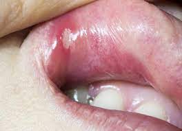 hiv mouth sores symptoms and