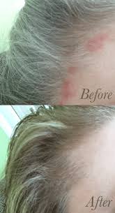sensitive skin red patches