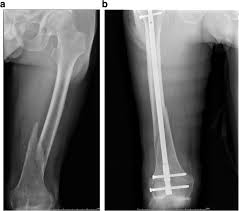 distal femur fractures