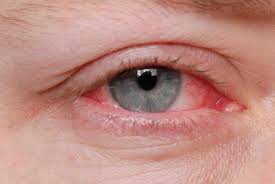 conjunctivitis pink eye eye health