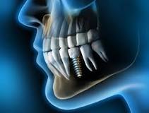 Image result for Dental implants for head and neck cancer patients