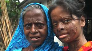 Bd face akter facebook / foods that look amazing but taste terrible : Bangladeshi Acid Attack Victim Hasina Akter Finds Empowerment Faces The Man Who Disfigured Her Mama Asia Abc News