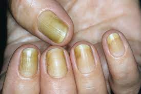 yellow nail syndrome springerlink